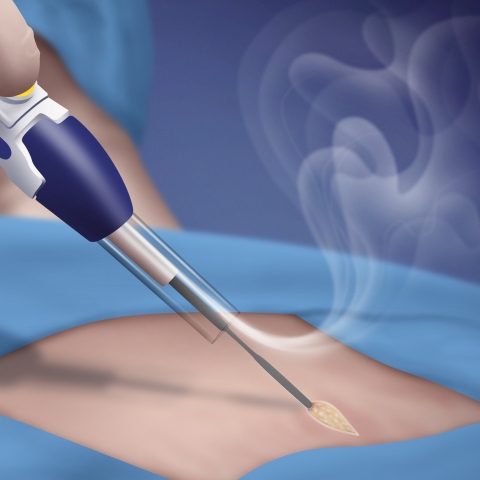 Open smoke evacuation surgical device system