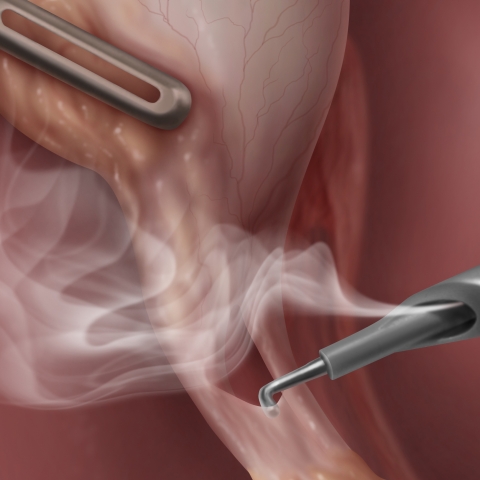 Laparoscopic smoke evacuation surgical device system