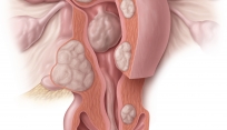 Uterine fibroids
